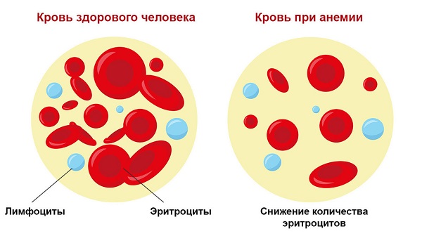 Кровь при анемии